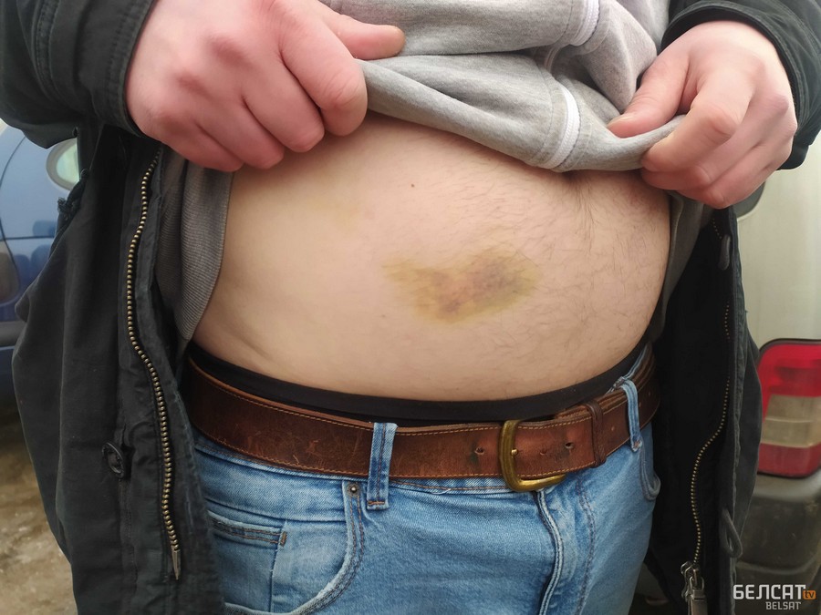 Bruises on Soltan’s belly. Photo: Belsat